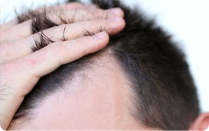 Hairox stops hair loss